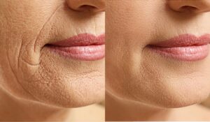 Lipfiller, hyaluron pen